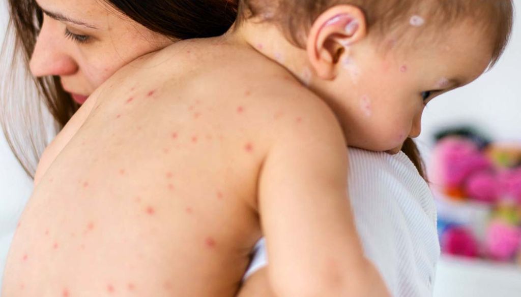 Alertan necesidad intensificar medidas ante persistencia de sarampión en las Américas 