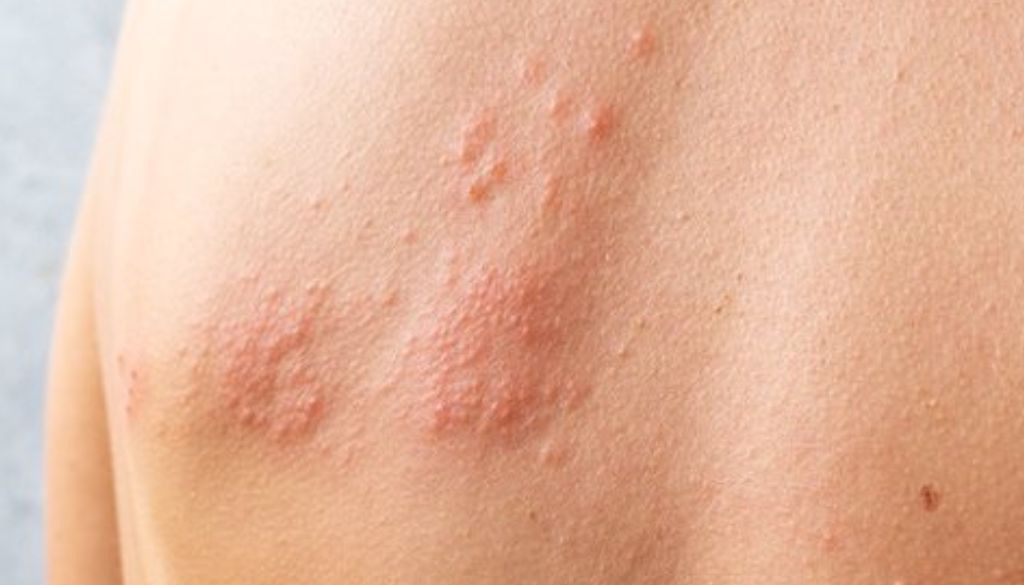 Herpes zóster, una amenaza silenciosa que puede causar dolor incapacitante 