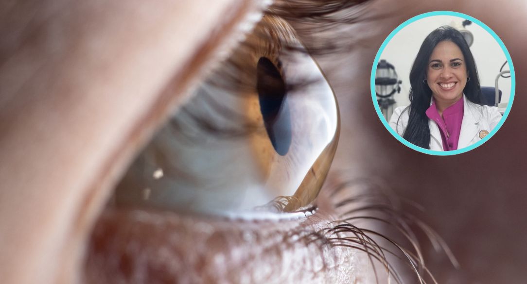 Advierten frotarse los ojos puede empeorar el queratocono 