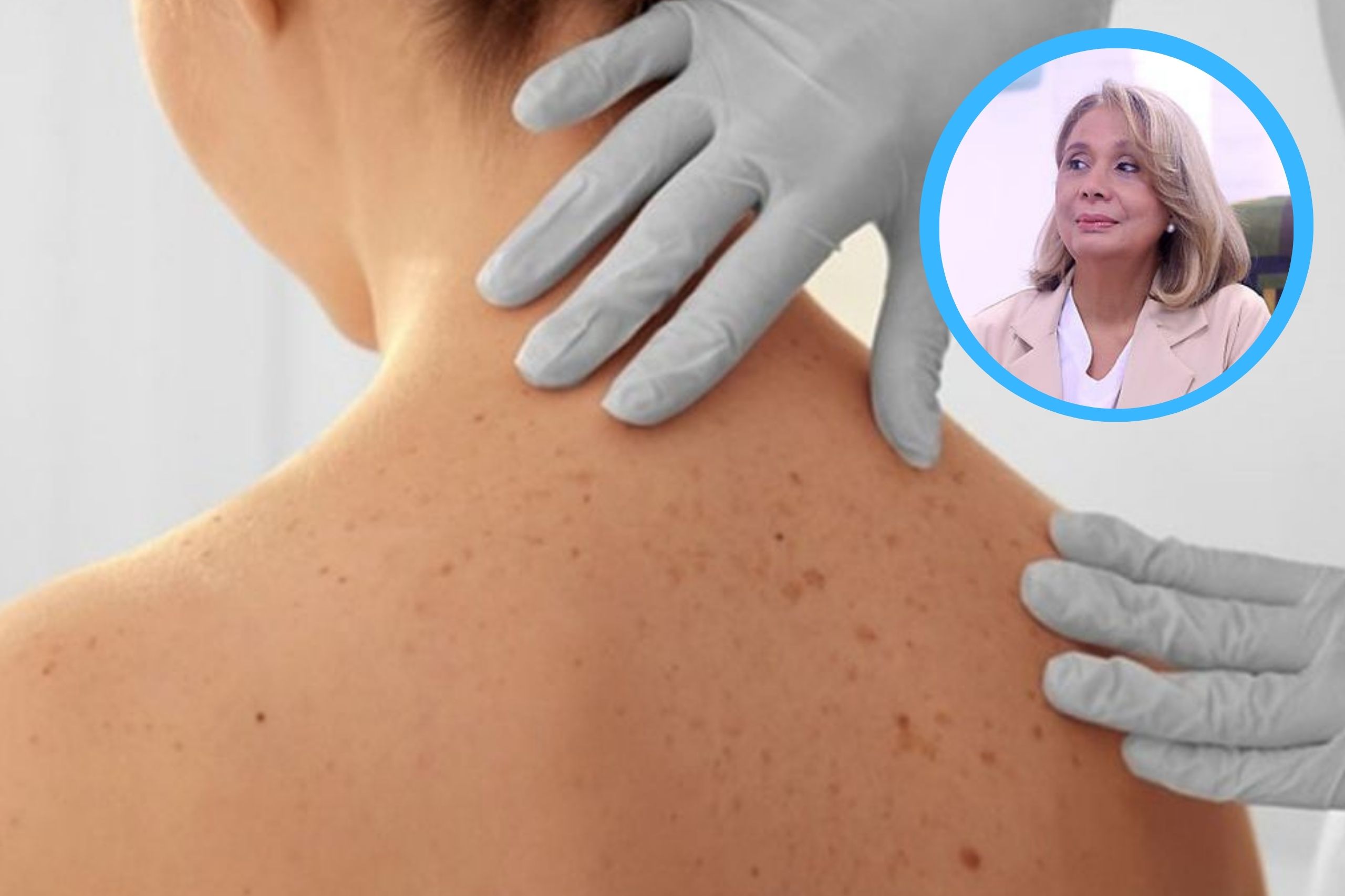 Dermatóloga advierte sobre aumento en cáncer de piel e importancia de su detección temprana 